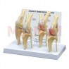 Canine knee model with disease stages, set of 4 models illustrate degenerative joint disease (osteoarthritis). Healthy knee